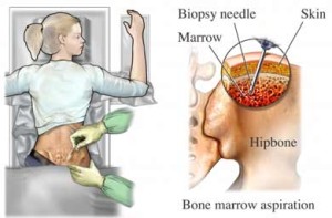 Bone_Marrow_Biopsy
