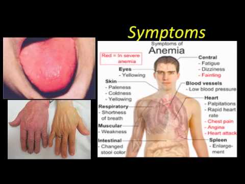 iron deficiency anemia symptoms