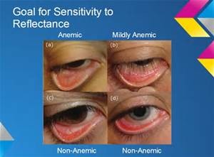 anemia seen in eye