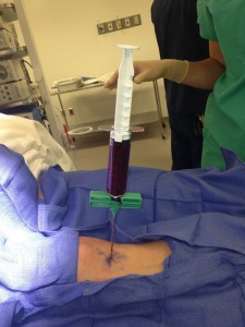 bone marrown aspiration needle