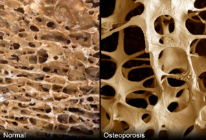 webmd_rm_photo_of_porous_bonesWNL vs diseased live