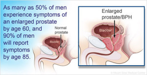 Normal Prostate vs. Benign Prostatic Hyperplasia