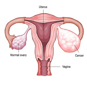 ovarian-cancer2