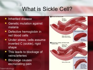sickle cell disease 2