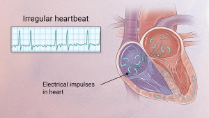 afib