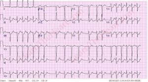 afib RVR