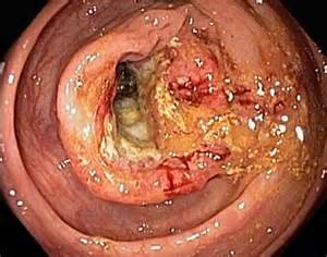 COLON CANCER