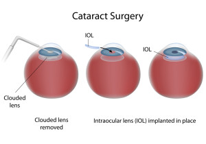 Cataract-diagram1