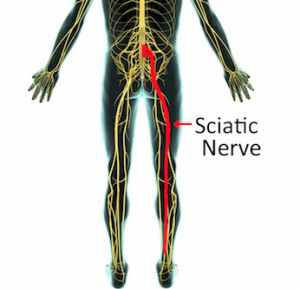 Sciatica2