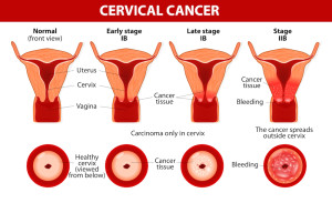 Cervical Cancer. Carcinoma of Cervix. Malignant neoplasm arising from cells in the cervix uteri. Vaginal bleeding. Vector diagram