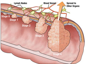 colon cancer stages