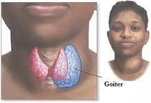 thyroid awareness goiter1