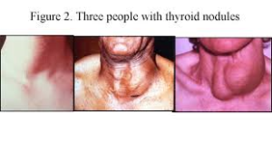 thyroidawarenessmonthGoiter2