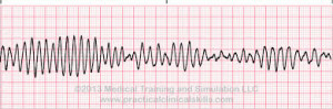 Torsades de pointes2