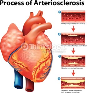 arteriosclerosis2