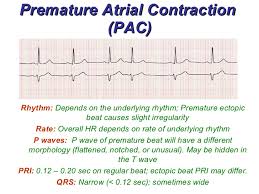 atrial rhythms4