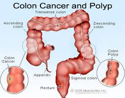 colorectal cancer1