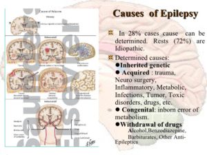 epilepsyIIb