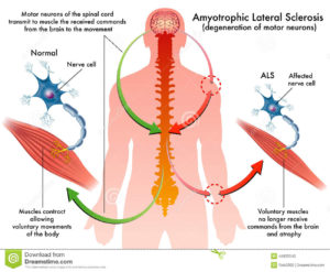 lou gerig disease2