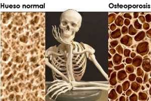 osteoporosis
