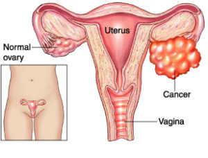 ovariancancer