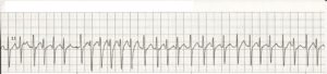 Afib with RVR 5