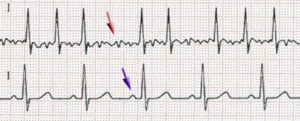 Afib with RVR 6