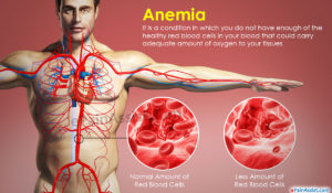 anemia