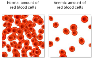 anemia