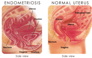 endometriosis2