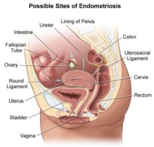 possible-sites-of-endometriosis