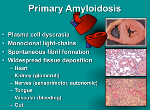 amyloidosis1