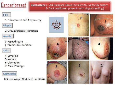 Breast cancer symptoms in pictures - Women Health Info Blog