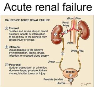 part-ii-kidney-failure