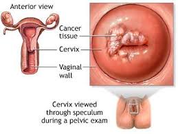 cervical-cancer-month5