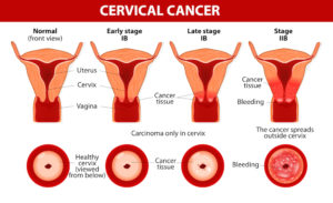 Cervical Cancer. Carcinoma of Cervix. Malignant neoplasm arising from cells in the cervix uteri. Vaginal bleeding. Vector diagram