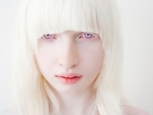 Albinism