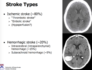 Part III Stoke Awareness – Treatment and How to prevent a stroke