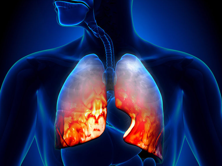 Acute lower respiratory infections! | Strive For Good Health