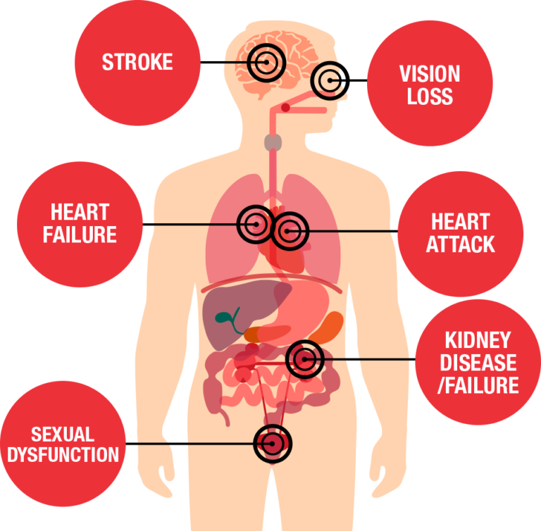 high-blood-pressure-and-kidney-disease-strive-for-good-health